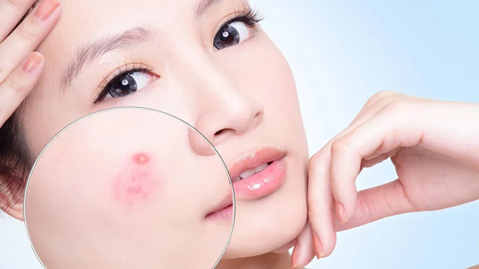 A Guide to Japanese Facial Acne Products: Clearer Skin, the Japanese Way